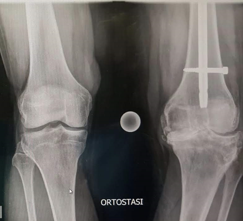 rx artrosi post traumatica paziente