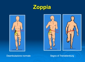 foto zoppia visita specialistica ortopedica all'anca